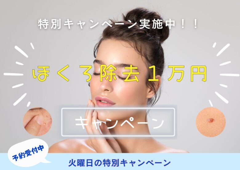 ほくろ1万円キャンペーン ほくろ1万円キャンペーン