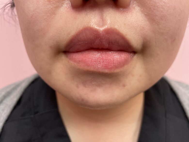 黒ずみ治療ピンク（リップ）