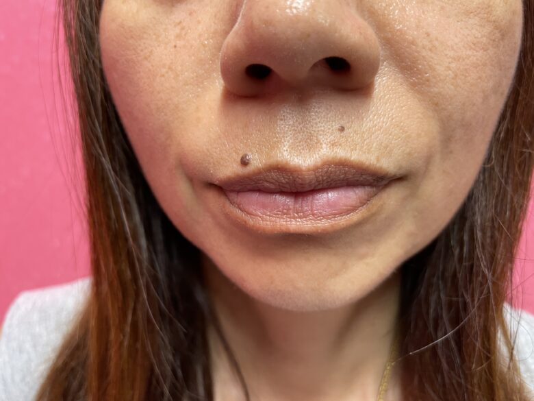 黒ずみ治療ピンク（リップ）