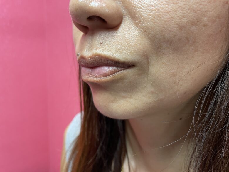 黒ずみ治療ピンク（リップ）