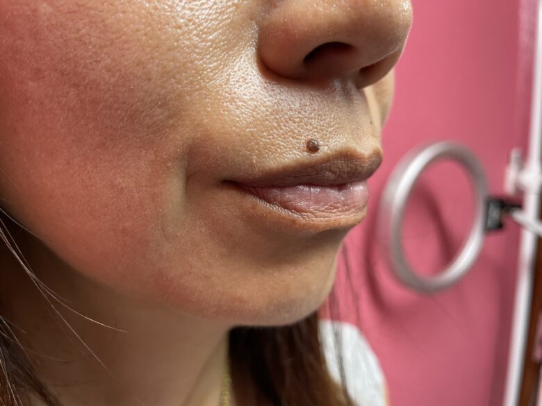 黒ずみ治療ピンク（リップ）