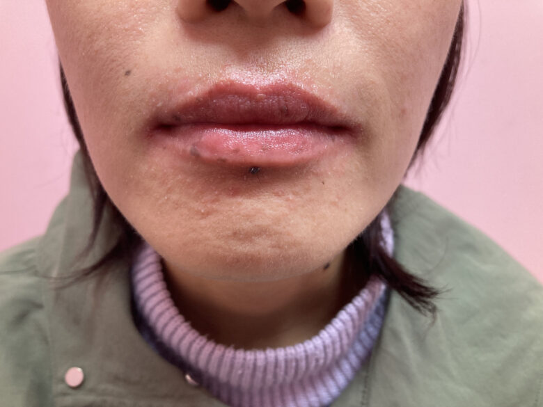 黒ずみ治療ピンク（リップ）