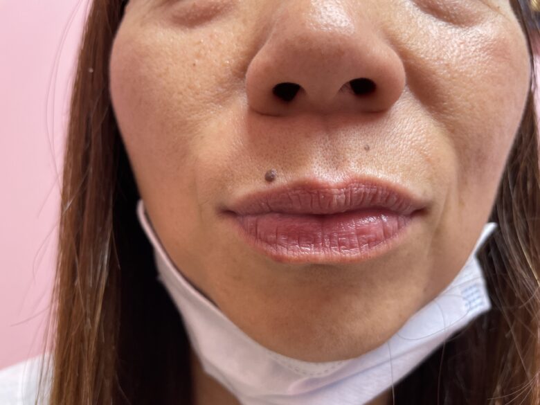 黒ずみ治療ピンク（リップ）