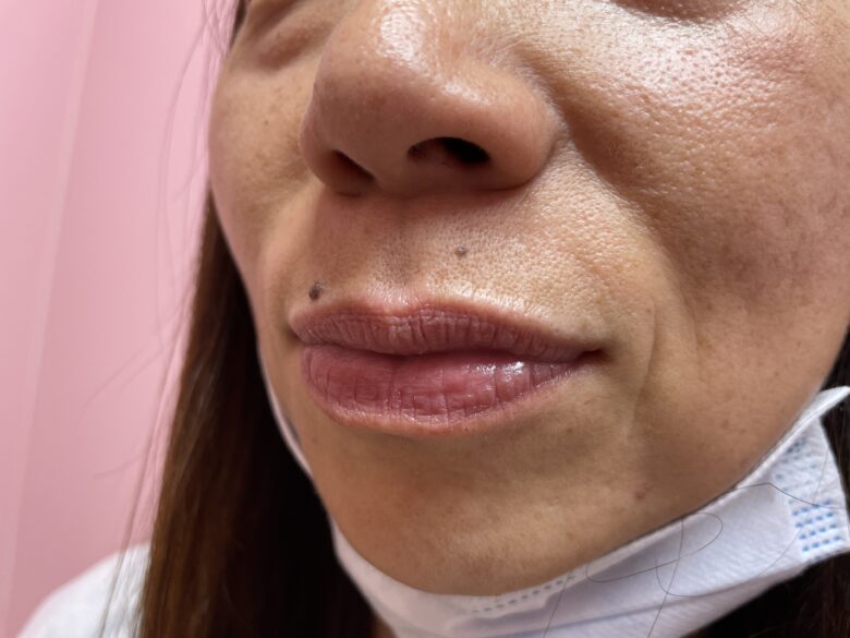 黒ずみ治療ピンク（リップ）