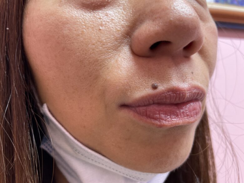 黒ずみ治療ピンク（リップ）