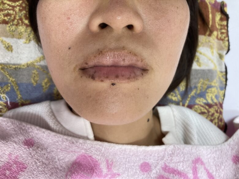 黒ずみ治療ピンク（リップ）